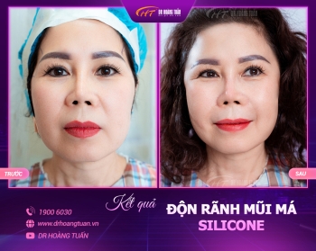 ĐỘN RÃNH MŨI MÁ